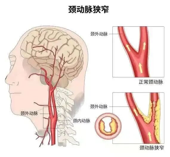 颈动脉斑块，血管里的“沉默隐患”